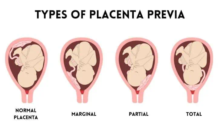 low lying placenta types of placenta previa