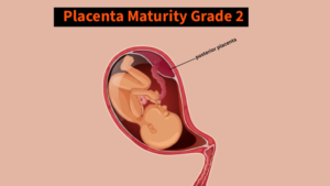 Placenta Maturity Grade 2 at 32 Weeks