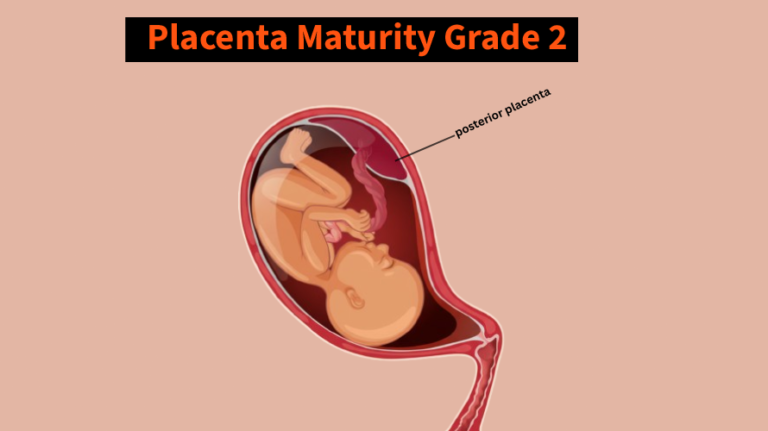 Placenta Maturity Grade 2 at 32 Weeks