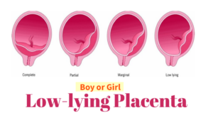 Low Lying Placenta Means Boy or Girl
