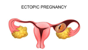 ectopic pregnancy ultrasound